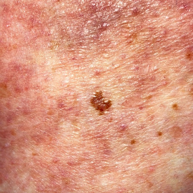 The 3 Types of Skin Cancer You Should Know About | Skinspect | Botany